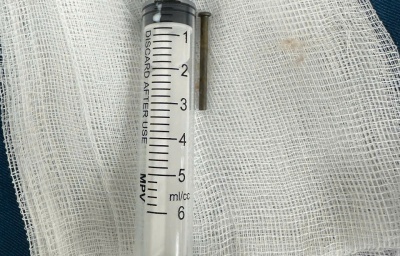 Gắp dị vật đinh sắt dài 3cm